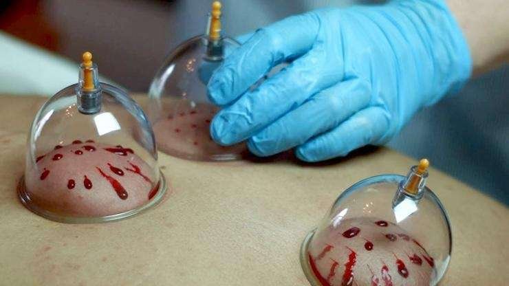 wet cupping therapy wet cupping therapy