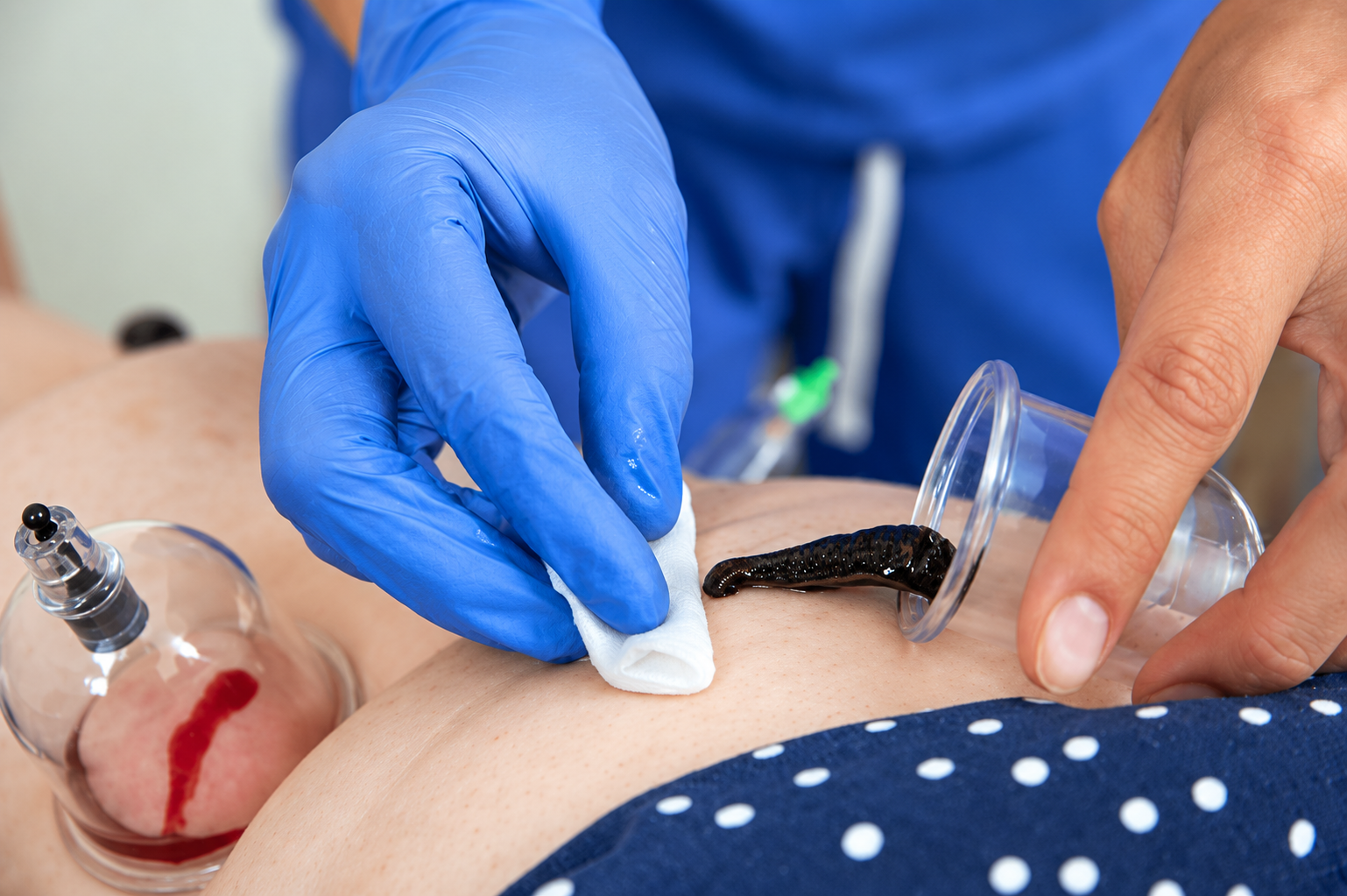 Sangsues médicinales en traitement