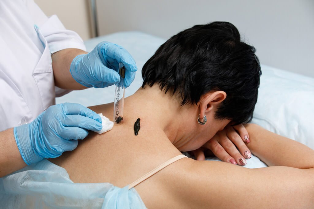 Hirudothérapie sangsues médicinales Genève