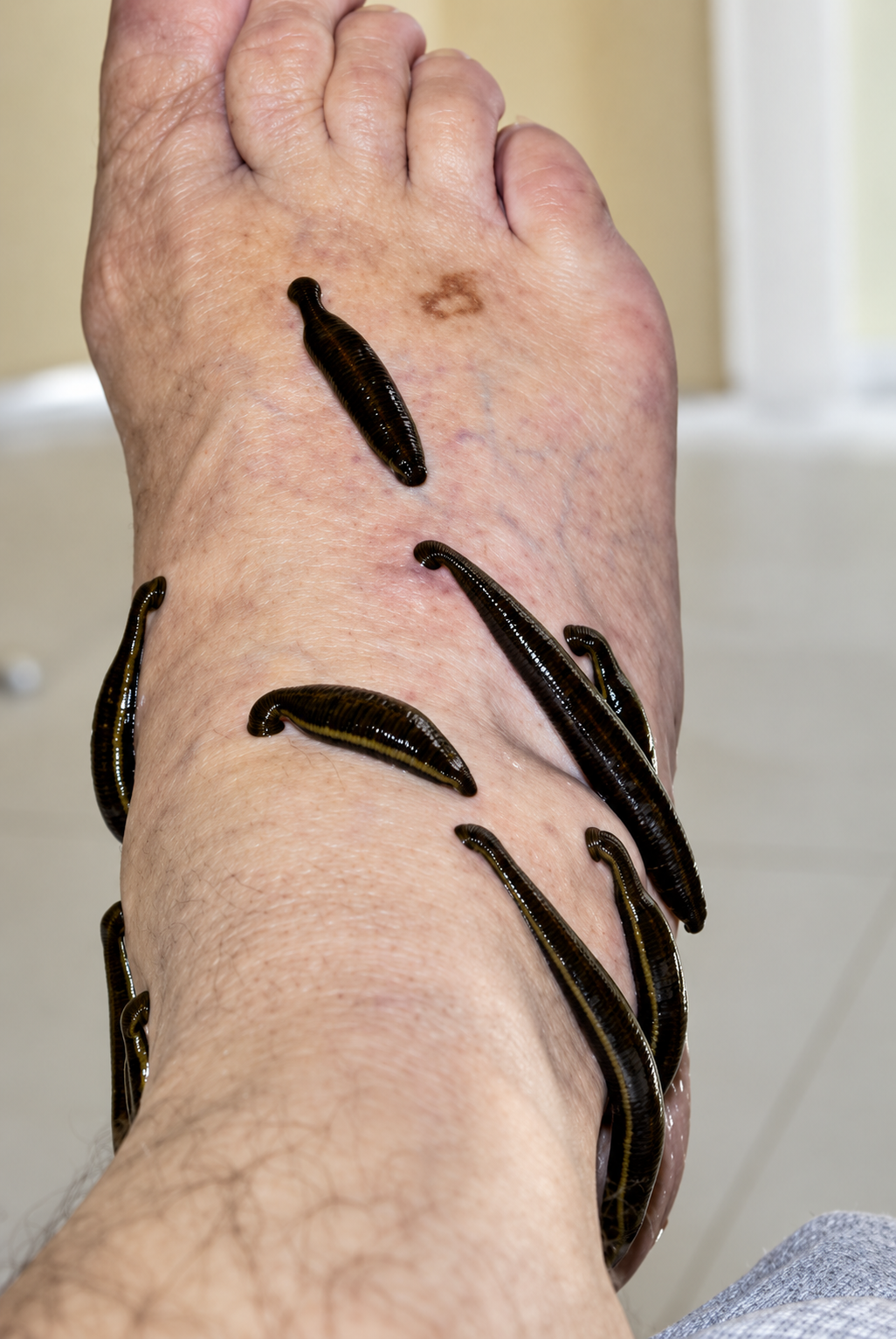 Hirudothérapie jambes légèreté